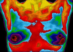Breast Thermography